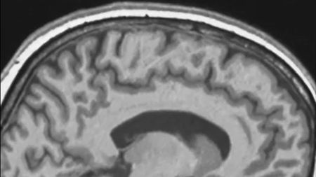 A grayscale side view of an image of the brain with patches of darker and lighter gray areas